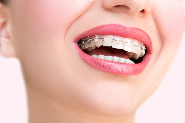 How Clear Braces Can Give You Straighter Teeth