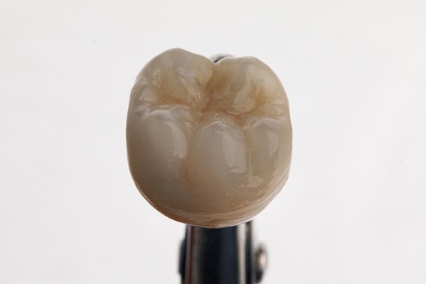 How Many Years Do Dental Crowns Last On Average?